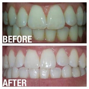 Whitening Toothpaste